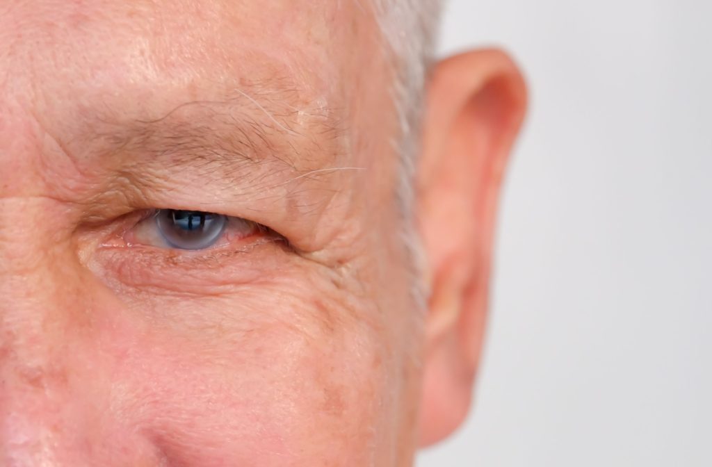 An older man with cataracts.